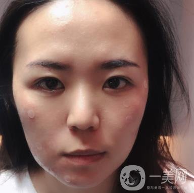 吉大一院整形美容科價(jià)格表費(fèi)用明細(xì)，附祛斑案例