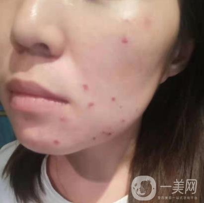 吉大一院整形美容科價(jià)格表費(fèi)用明細(xì)，附祛斑案例