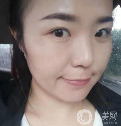 吉大一院整形美容科價(jià)格表費(fèi)用明細(xì)，附祛斑案例
