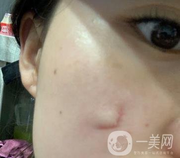 河北省中醫(yī)院整形美容科去疤*果如何？?jī)r(jià)格表及案例實(shí)拍圖公布