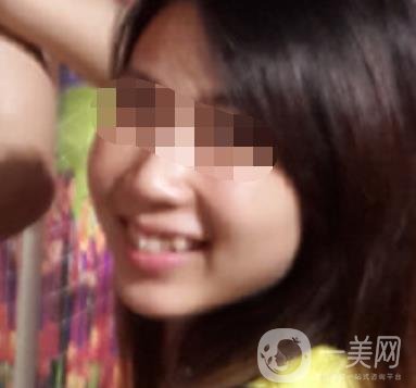 南昌大學第二附屬醫(yī)院整牙60天案例，還有價格表哦