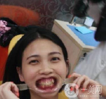 南昌大學第二附屬醫(yī)院整牙60天案例，還有價格表哦