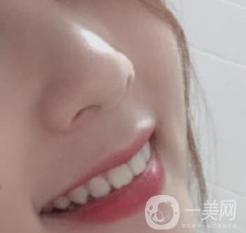 南昌大學第二附屬醫(yī)院整牙60天案例，還有價格表哦