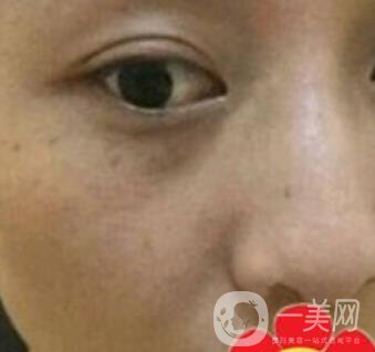 南方醫(yī)科大學(xué)南方醫(yī)院祛斑*果咋樣_案例_價格表