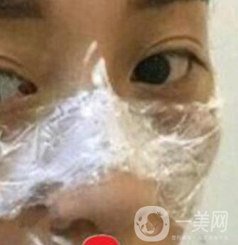 南方醫(yī)科大學(xué)南方醫(yī)院祛斑*果咋樣_案例_價格表