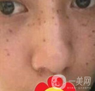 南方醫(yī)科大學(xué)南方醫(yī)院祛斑*果咋樣_案例_價格表