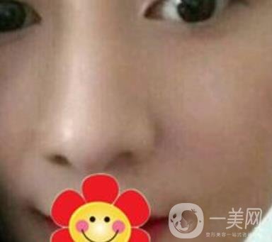南方醫(yī)科大學(xué)南方醫(yī)院祛斑*果咋樣_案例_價格表