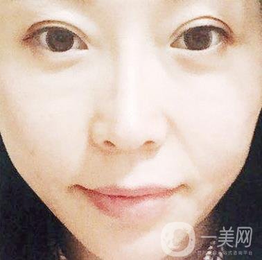 蘭州軍區(qū)陸軍總院皮膚科價(jià)格表_祛痣案例展示