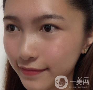 沈陽軍區(qū)總醫(yī)院整形外科價格表2020，附雙眼皮案例