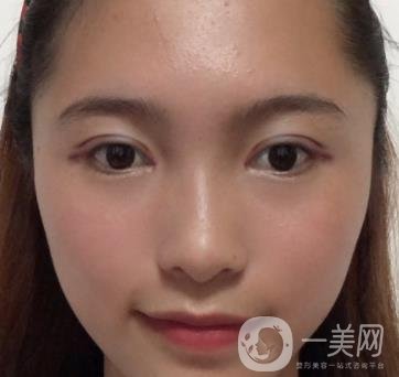 沈陽軍區(qū)總醫(yī)院整形外科價格表2020，附雙眼皮案例