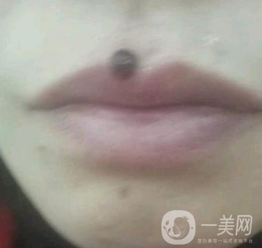 鹽城東方女子整形醫(yī)院價格表_點痣*果一覽