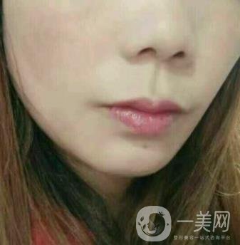鹽城東方女子整形醫(yī)院價格表_點痣*果一覽
