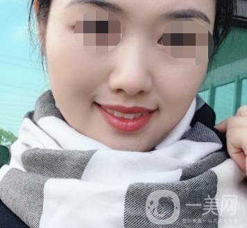 鹽城東方女子整形醫(yī)院價格表_點痣*果一覽