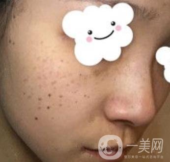 浙二醫(yī)院整形美容科價格表*新版，附激光祛斑*終*果圖