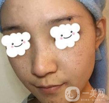 浙二醫(yī)院整形美容科價格表*新版，附激光祛斑*終*果圖