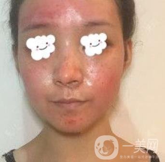 浙二醫(yī)院整形美容科價格表*新版，附激光祛斑*終*果圖