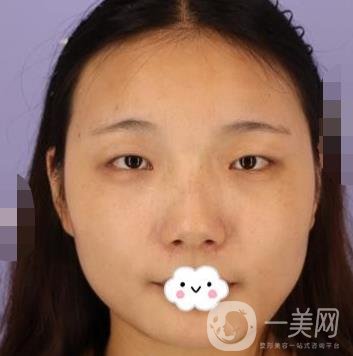 北京安貞醫(yī)院整容怎么樣？李斌斌修復雙眼皮怎么樣？內含案例及價格表