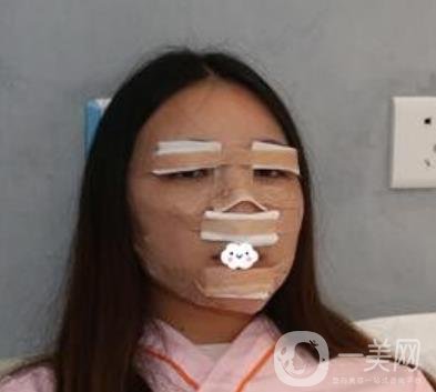 北京安貞醫(yī)院整容怎么樣？李斌斌修復雙眼皮怎么樣？內含案例及價格表
