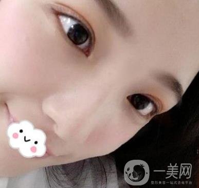 北京安貞醫(yī)院整容怎么樣？李斌斌修復雙眼皮怎么樣？內含案例及價格表