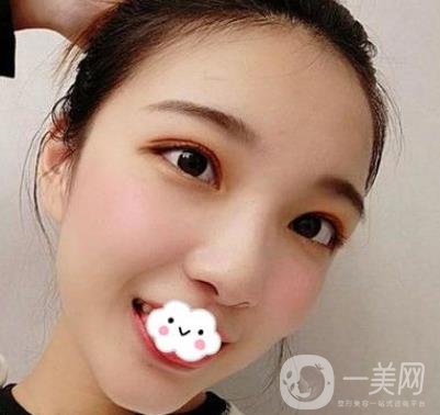 北京安貞醫(yī)院整容怎么樣？李斌斌修復雙眼皮怎么樣？內含案例及價格表