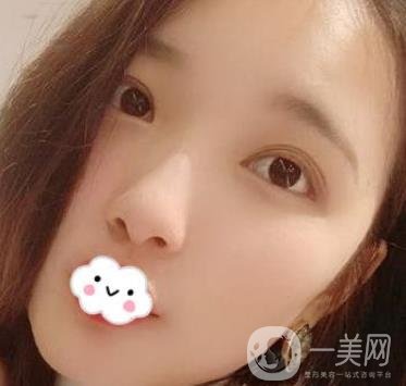 北京安貞醫(yī)院整容怎么樣？李斌斌修復雙眼皮怎么樣？內含案例及價格表