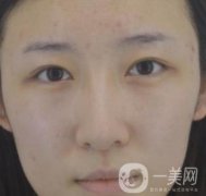 北京克萊美舍張冰潔雙眼皮評價怎么樣？案例及價格表一覽