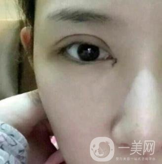 北京克萊美舍張冰潔雙眼皮評價怎么樣？案例及價格表一覽