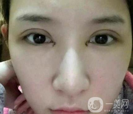 北京克萊美舍張冰潔雙眼皮評價怎么樣？案例及價格表一覽