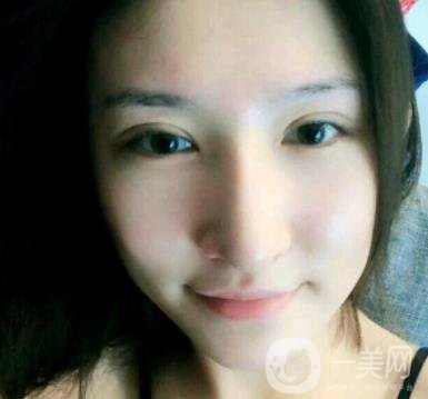 北京克萊美舍張冰潔雙眼皮評價怎么樣？案例及價格表一覽