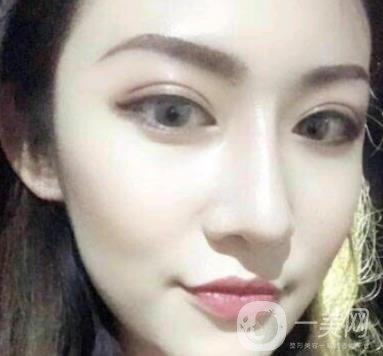 北京克萊美舍張冰潔雙眼皮評價怎么樣？案例及價格表一覽