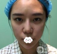 師俊莉醫(yī)生脂肪填充面部果及價(jià)格表一覽