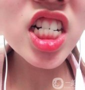 301醫(yī)院整牙費用表一覽，附牙齒矯正案例展示