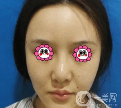 長沙中南大學(xué)*三醫(yī)院整形美容外科隆鼻多少錢？價格表及案例詳情