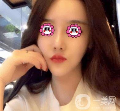 長沙中南大學(xué)*三醫(yī)院整形美容外科隆鼻多少錢？價格表及案例詳情