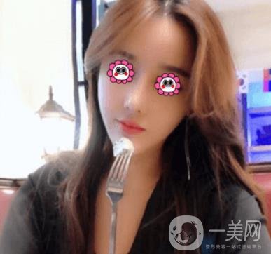 長沙中南大學(xué)*三醫(yī)院整形美容外科隆鼻多少錢？價格表及案例詳情