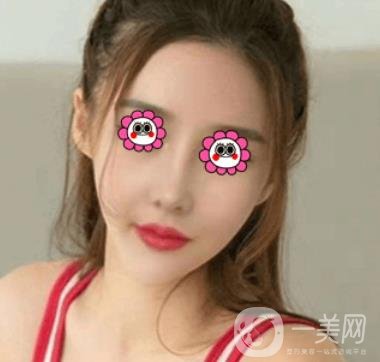 長沙中南大學(xué)*三醫(yī)院整形美容外科隆鼻多少錢？價格表及案例詳情