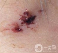 泰安市中心醫(yī)院美容整形科價格表,附祛疤案例果分享