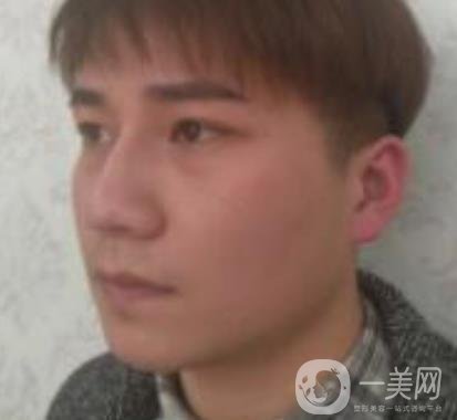 棗莊市立醫(yī)院燒傷整形美容科做光子嫩膚好嗎？價格表及術(shù)后*果分享