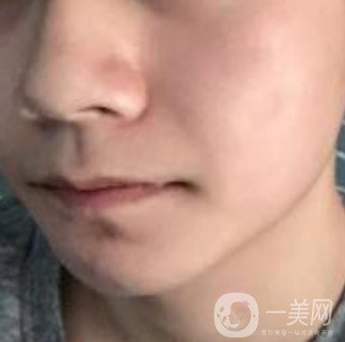 棗莊市立醫(yī)院燒傷整形美容科做光子嫩膚好嗎？價格表及術(shù)后*果分享