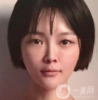 石家莊市醫(yī)院整形美容外科價格表2020，附雙眼皮實例