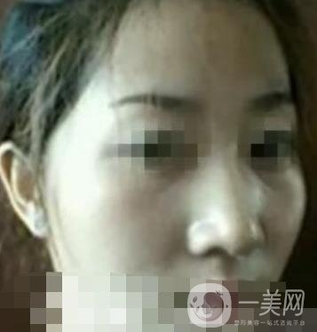 邢臺市人民醫(yī)院美容科陳譽(yù)華*案例_價(jià)格表明細(xì)