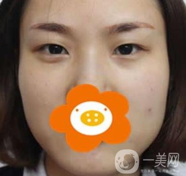 成都*做雙眼皮前后*果圖，附整形美容科價格收費(fèi)表一覽