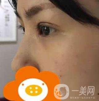 成都*做雙眼皮前后*果圖，附整形美容科價格收費(fèi)表一覽