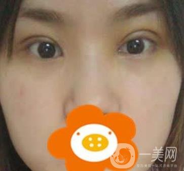 成都*做雙眼皮前后*果圖，附整形美容科價格收費(fèi)表一覽