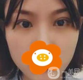 成都*做雙眼皮前后*果圖，附整形美容科價格收費(fèi)表一覽