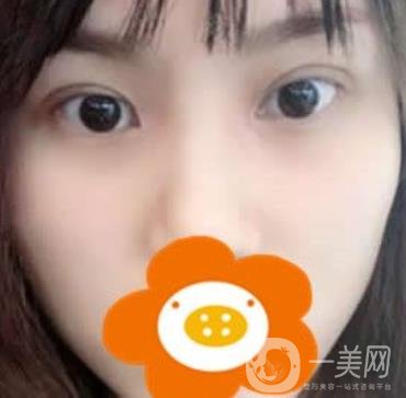 成都*做雙眼皮前后*果圖，附整形美容科價格收費(fèi)表一覽