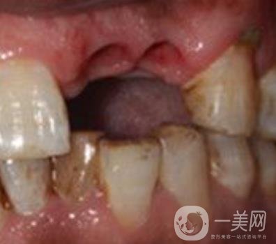 中大光華口腔醫(yī)院種植牙多少錢?價(jià)格表2020年項(xiàng)目明細(xì)一覽