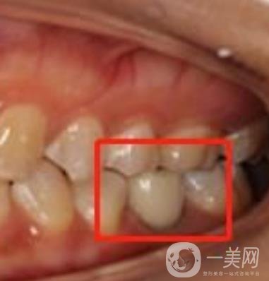 中大光華口腔醫(yī)院種植牙多少錢?價(jià)格表2020年項(xiàng)目明細(xì)一覽