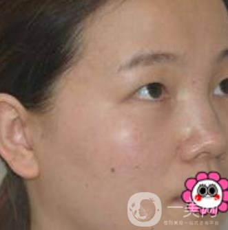 河南省人民醫(yī)院誰(shuí)做雙眼皮好？附案例及2020整形價(jià)格表