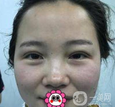 河南省人民醫(yī)院誰(shuí)做雙眼皮好？附案例及2020整形價(jià)格表